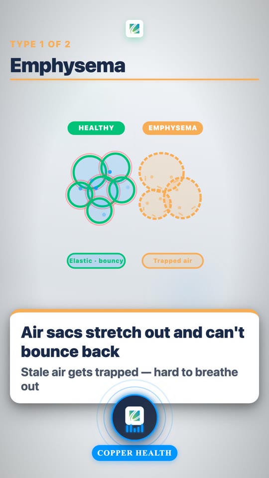 Understanding COPD