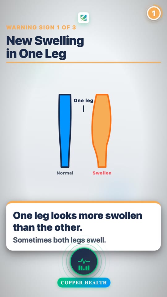 Spotting Blood Clots (DVT & PE)